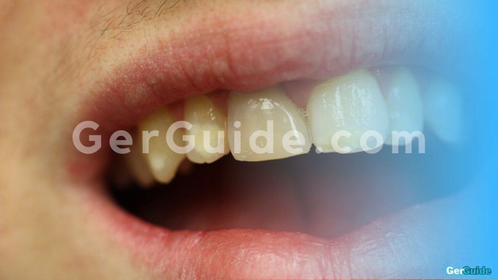 wie lange hattet ihr schmerzen nach wurzelbehandlung-1