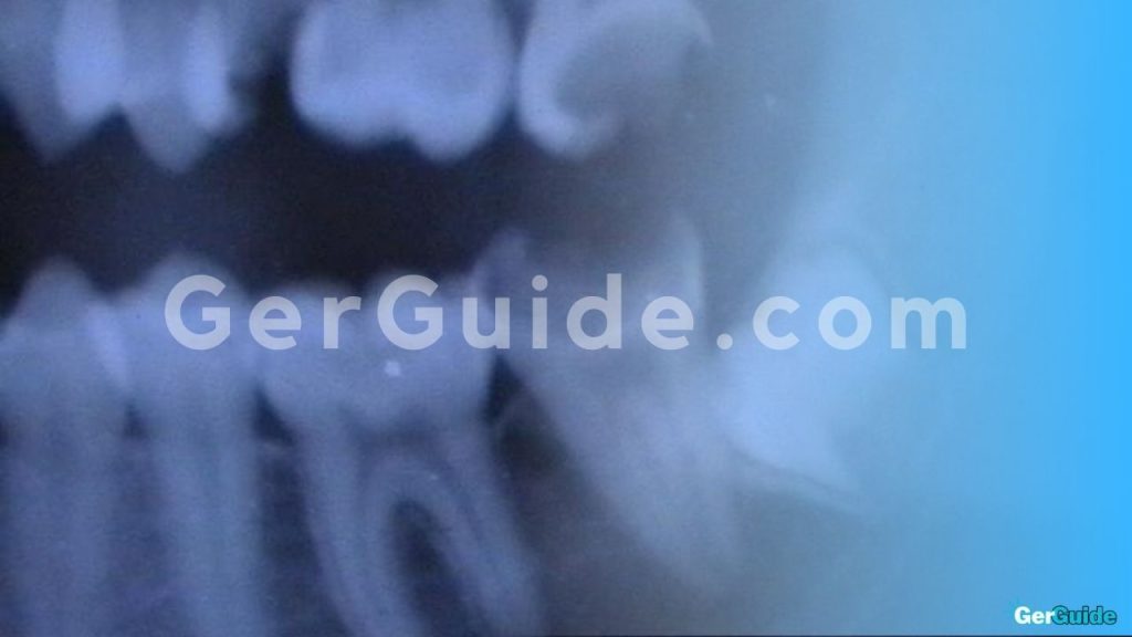 wie lange hattet ihr schmerzen nach wurzelbehandlung-2